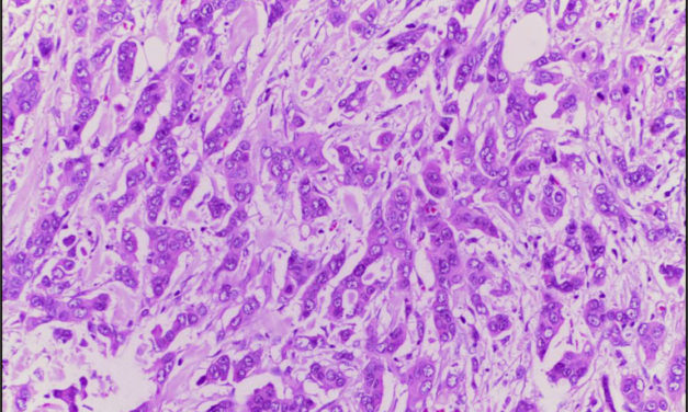 Més de 120 anys combatent el càncer de mama